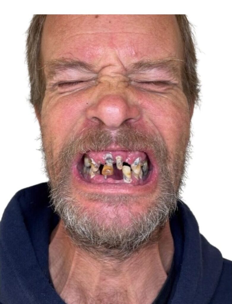 A middle-aged man with a beard and mustache shows his teeth while grimacing; many of his teeth are severely decayed, broken, or missing. He is wearing a dark hoodie and is set against a white background.