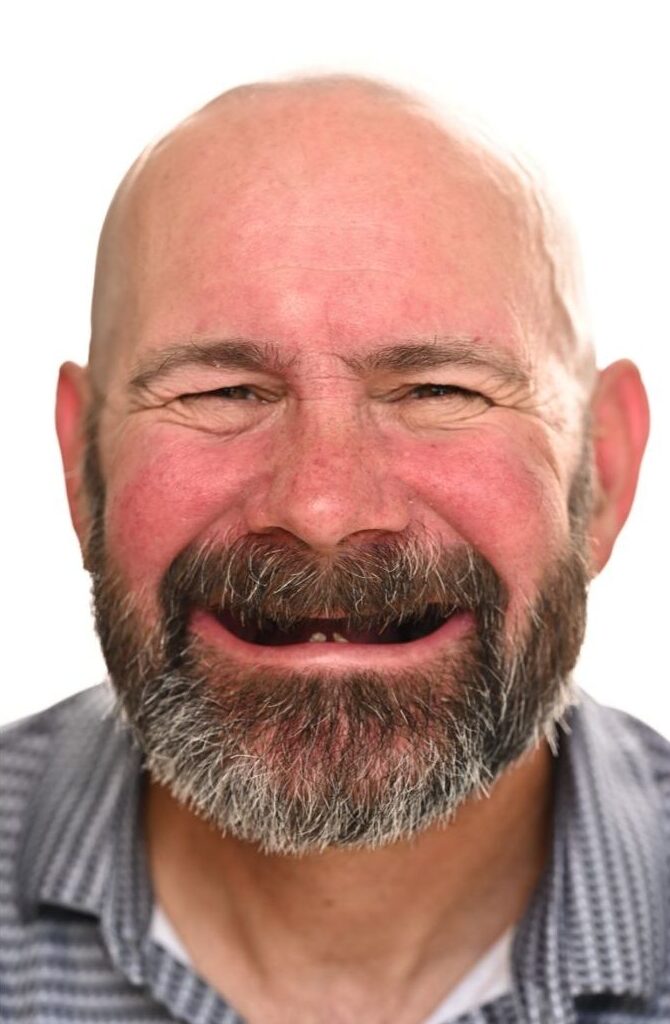 A middle-aged man with a bald head, gray beard, and mustache smiles widely, showing missing teeth. He is wearing a gray patterned shirt and is photographed against a plain white background.