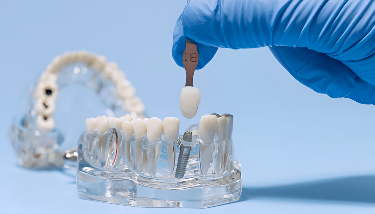 What are Same-Day Dental Implants?