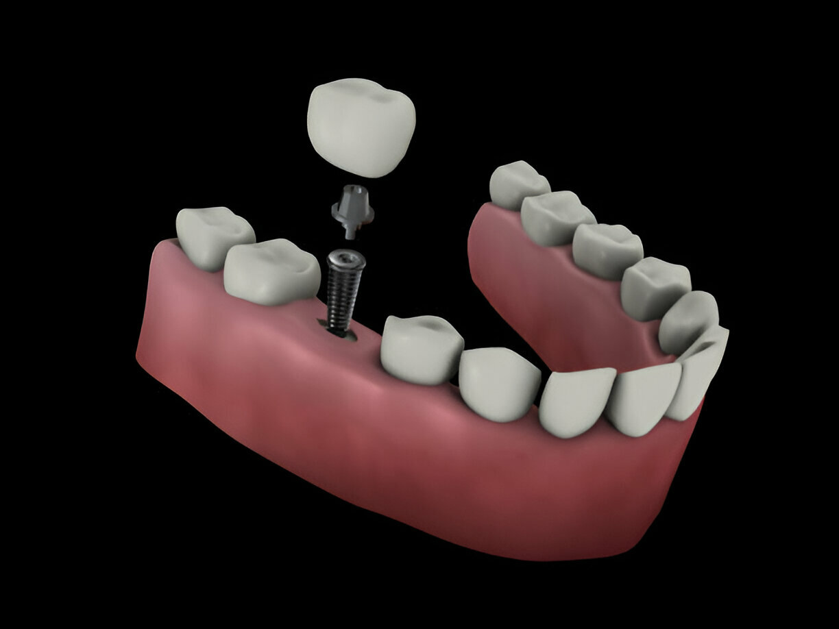 Bone Grafting Near You 