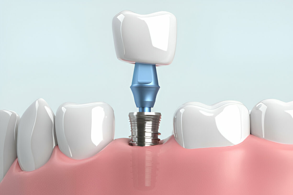 What is Bone Grafting?