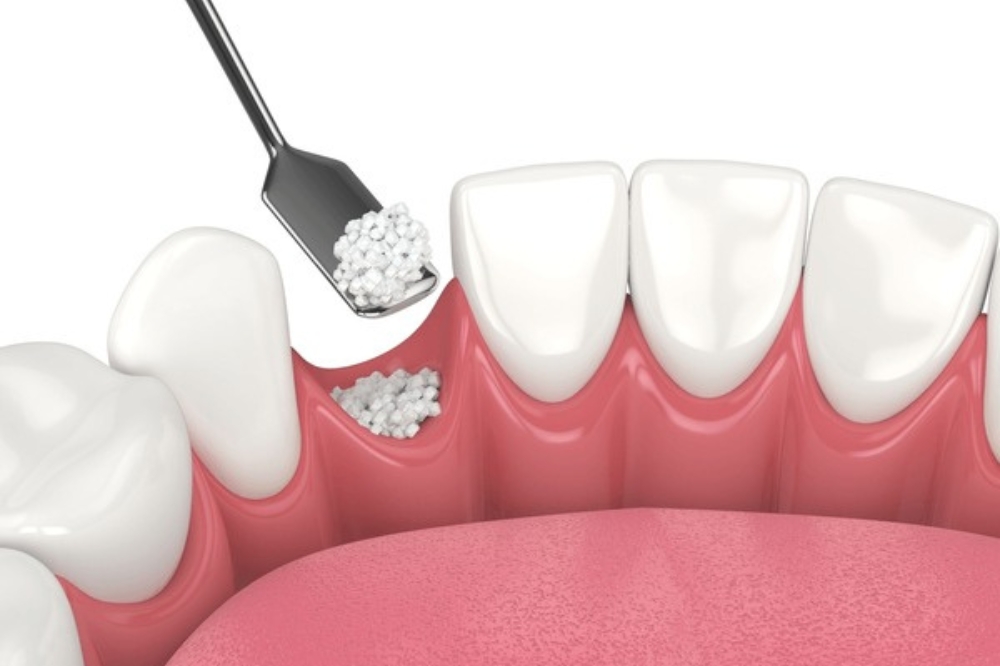 Dental Bone Grafting: What to Expect and How It Can Improve Your Smile