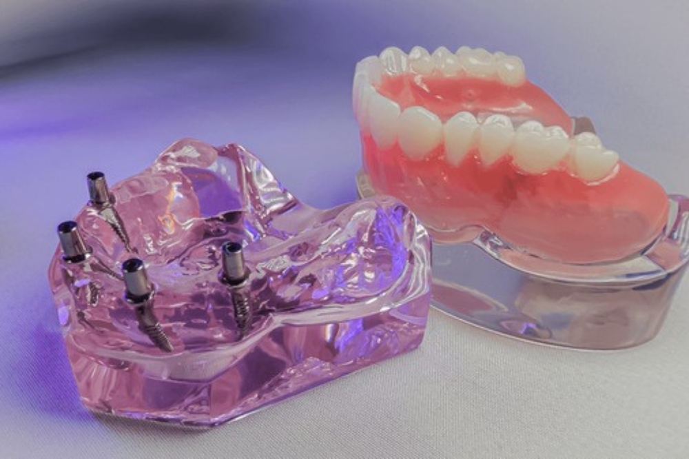 Implant-Supported Dentures: Why They Are A Smart Investment For Your Smile And Health