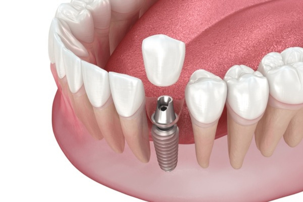 The Step-By-Step Process Of Getting A Single-Tooth Dental Implant